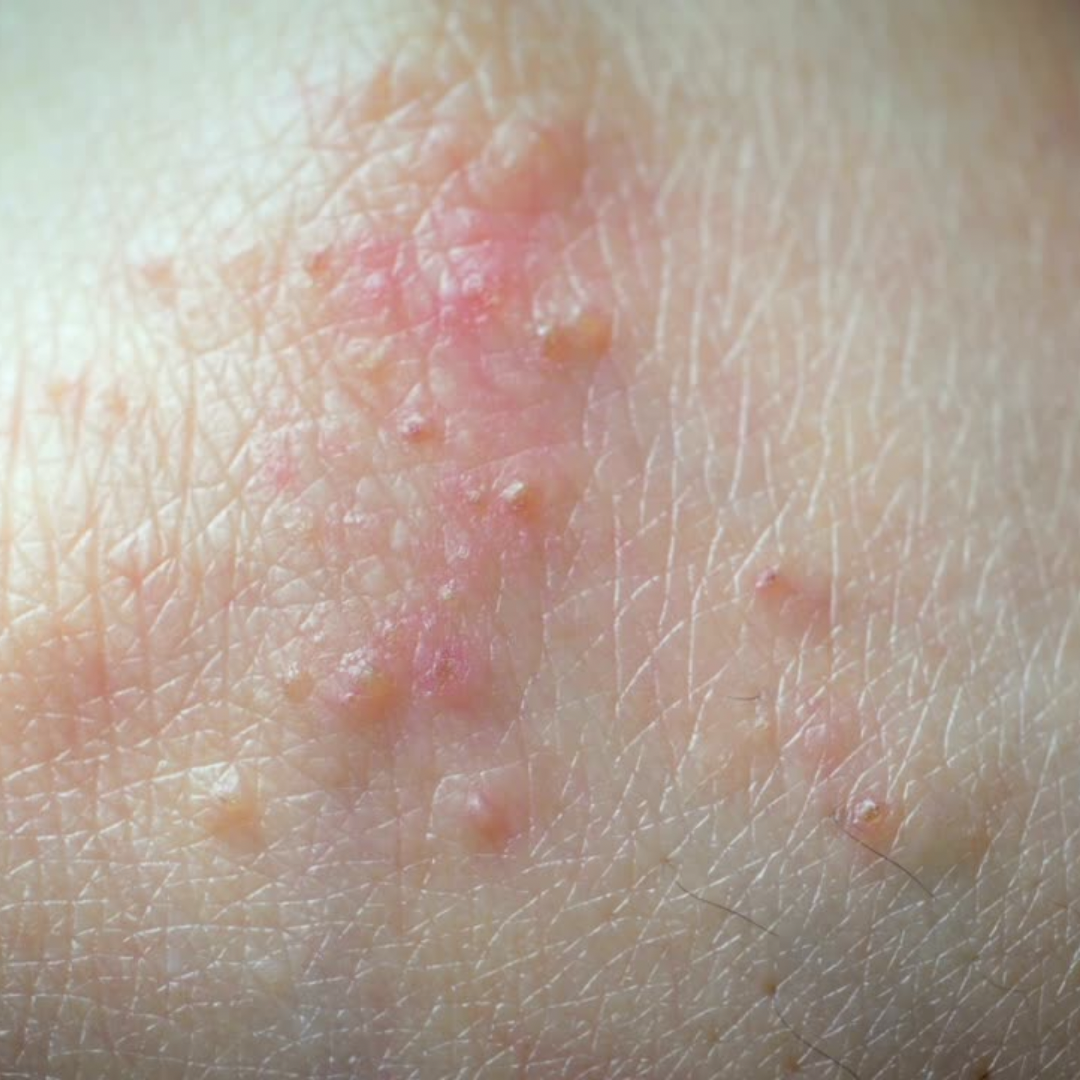 Eczema & Rash Eraser ™