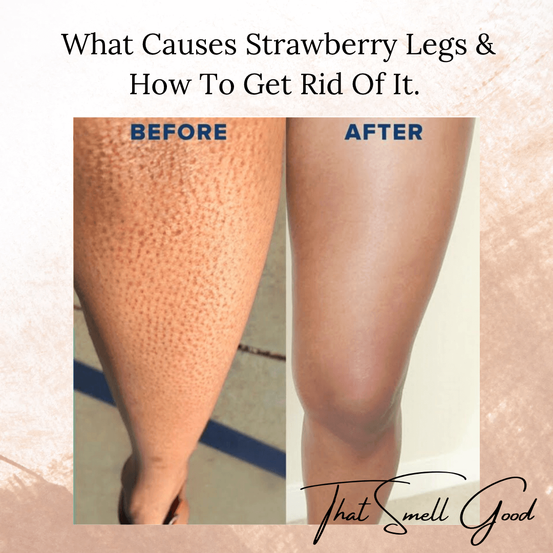 Struggling With Strawberry Legs?